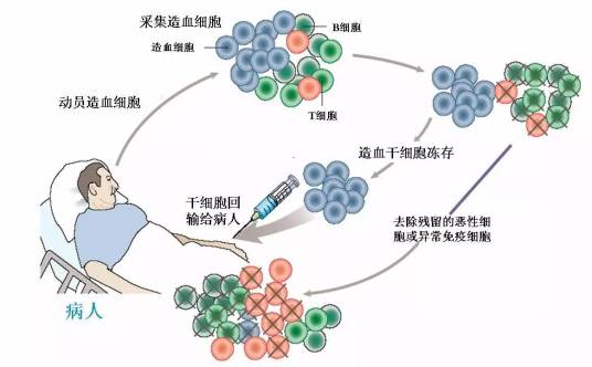 什么是干细胞移植治疗