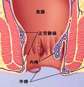 内痔疮