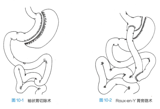 什么是手术减重