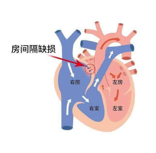 什么是房间隔缺损