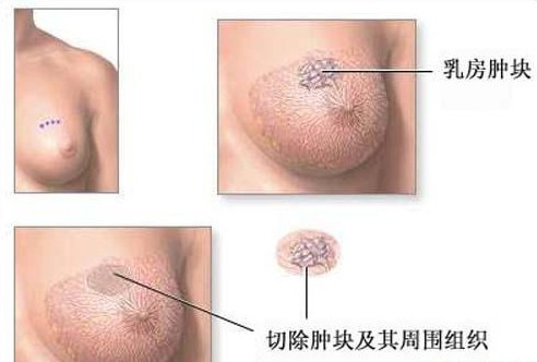 乳房包块