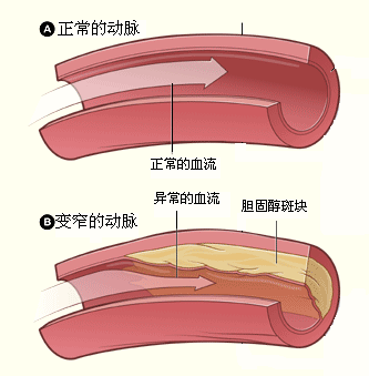 什么是冠状动脉狭窄