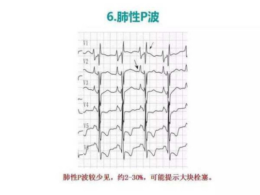 什么是肺性p波