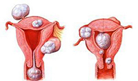 子宫肌瘤西医治疗