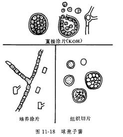 类球孢子菌病