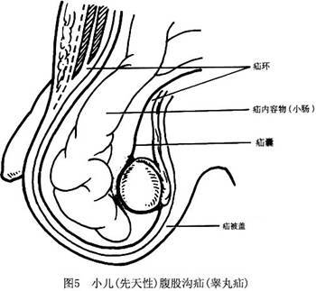 婴儿腹股沟斜疝