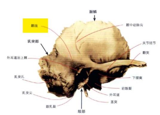 颞线