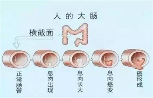 结直肠息肉病