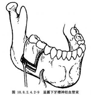 什么是下颌前庭根尖下截骨术