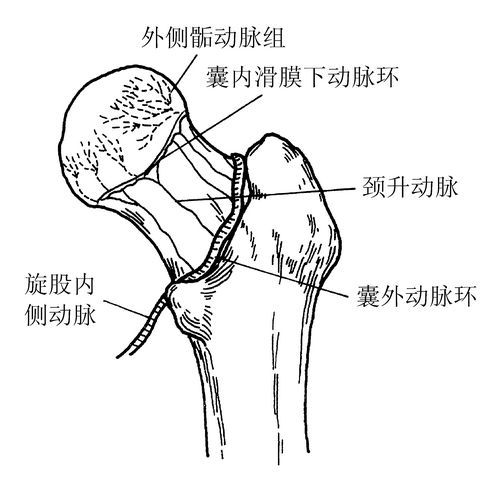 外伤型股骨头坏死