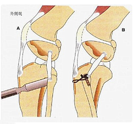 膝十字韧带重建术