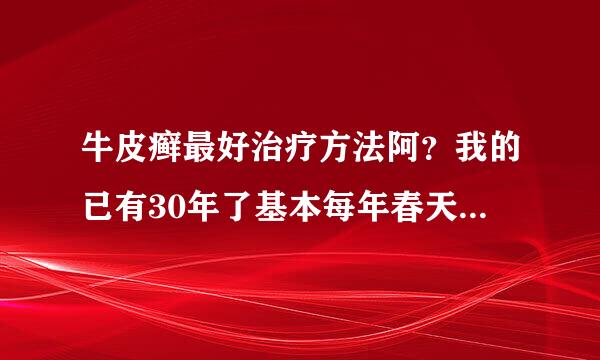 牛皮癣最好治疗方法阿？我的已有30年了基本每年春天都会发病然后吃清黛丸或者打激素针