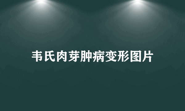 韦氏肉芽肿病变形图片