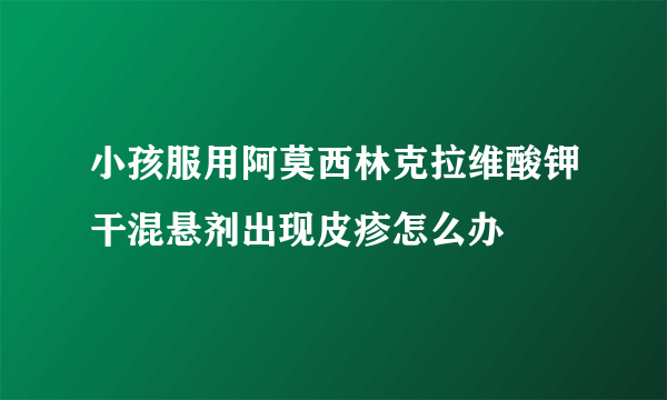 小孩服用阿莫西林克拉维酸钾干混悬剂出现皮疹怎么办